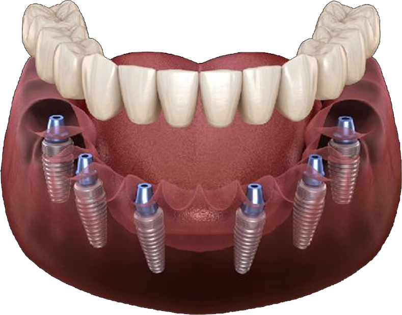 Протезирование <br> All-ON-6 на 6 имплантах OSSTEM